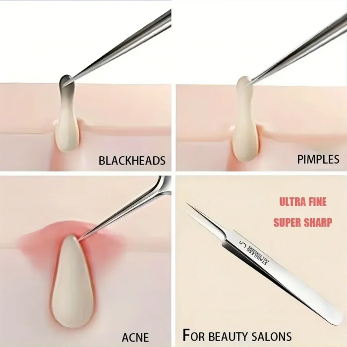 kf-Sa9fb50d930d4420bae0e296a45909cbfU 1 Pack Extra Fine No. 5 Cellular Acne Blackhead Tweezers - Facial Beauty Remove Acne Needle Tools for Skin Care - Image 5